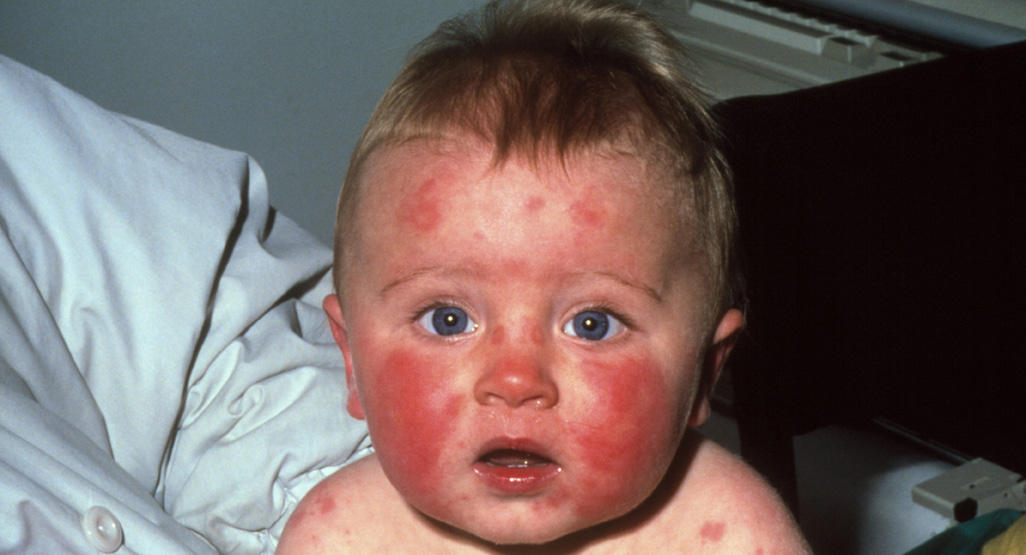 baby with red rash on face