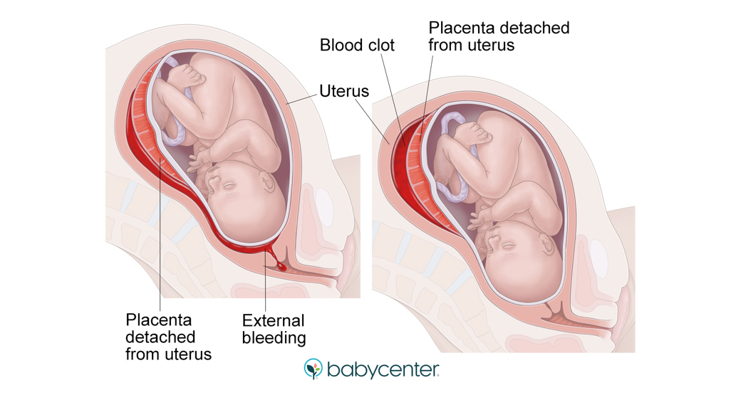 medical illustration of placental abruption with internal and external bleeding