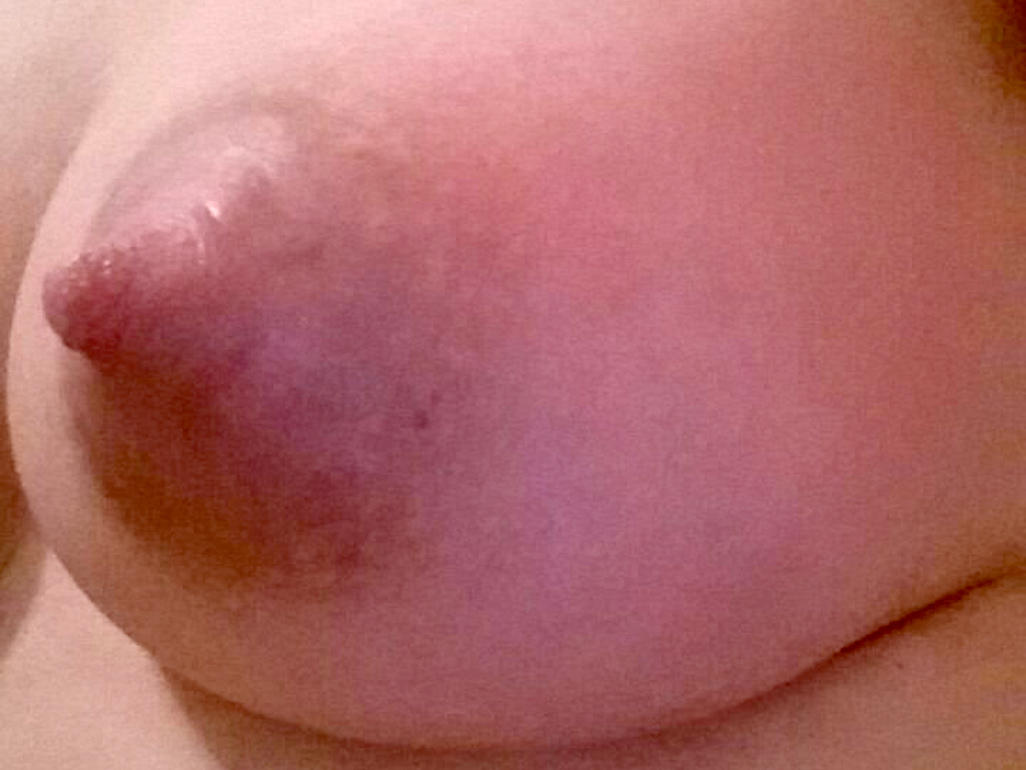 breast mastitis with red and tender skin